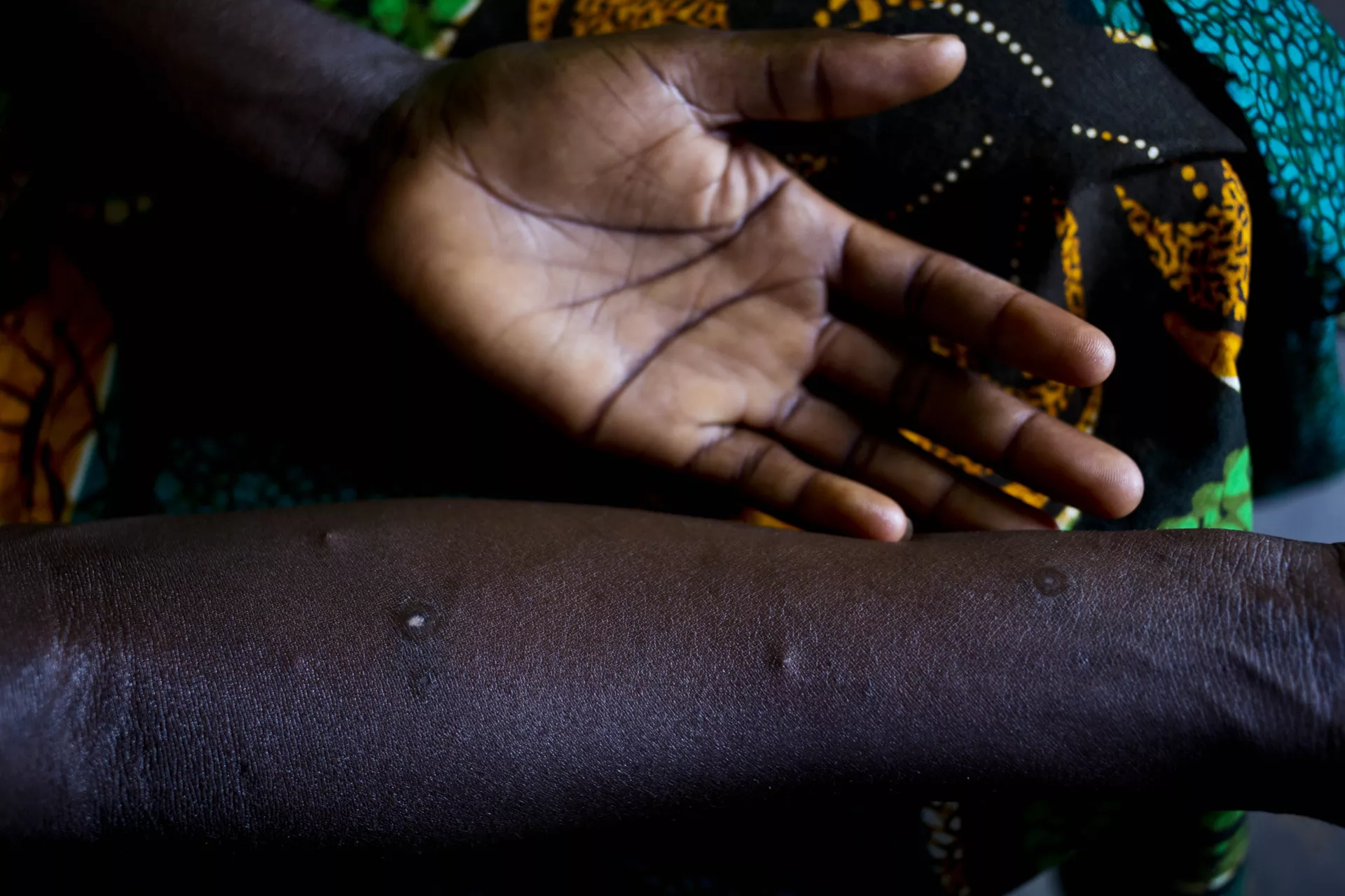 South Sudan. A teenager shows the scars she received during her time as a child soldier.